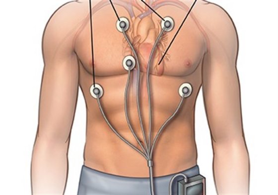 Holter monitorizasiyası