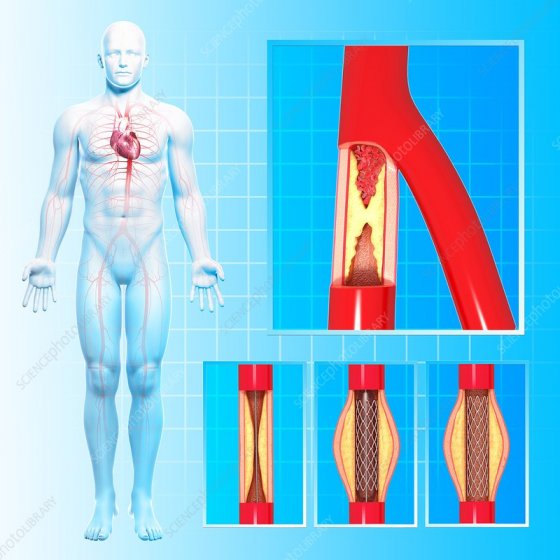 Aorta xəstəliklərində müdaxilələr (en)